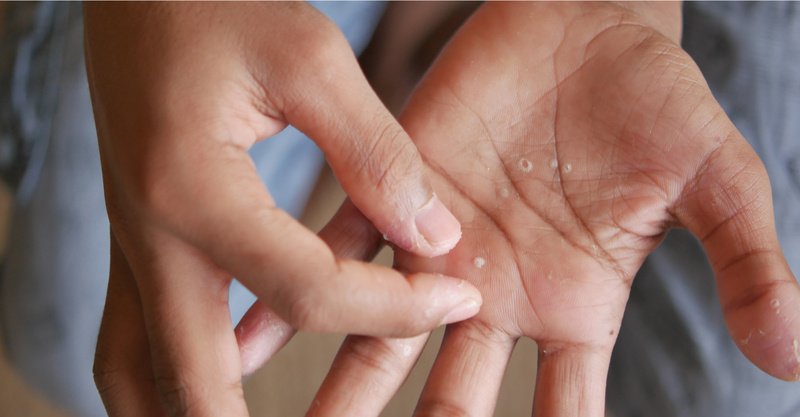 Plantar warts: Why urgent care is a great option for plantar wart removal