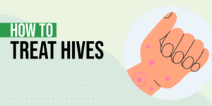 How to Treat Hives: 7 Home Remedies
