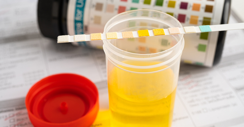 Glucose in urine: Symptoms, test, causes, and treatment