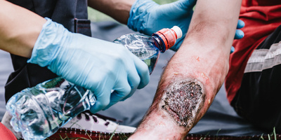 Fourth Degree Burns Types, Symptoms & Treatment