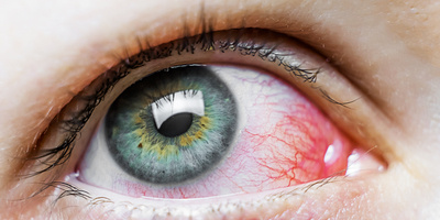 Viral vs bacterial pink eye: Understanding conjunctivitis