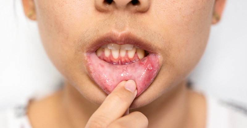 Oral herpes: Symptoms, treatment, and when to see a doctor