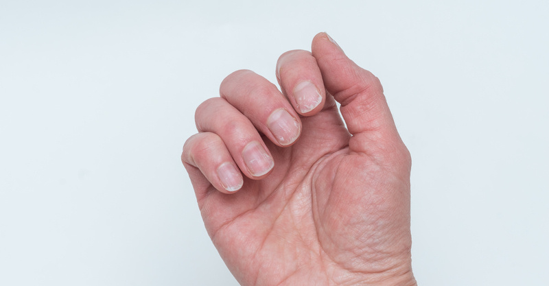 Onycholysis: When your nail lifts from the nail bed