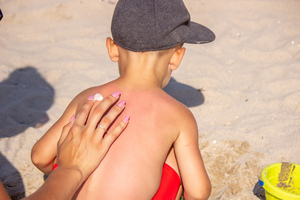 The best ways to prevent heat rash (especially for kids)