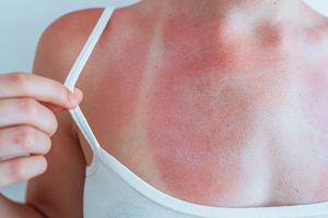 Sunburn relief fast: When you need more than aloe