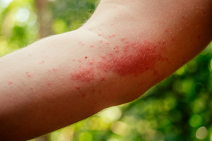 Allergic reaction or just a bug bite? When to go to urgent care