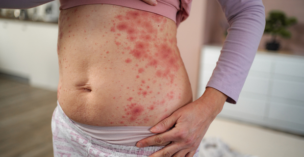 When to worry about a rash: An adult guide