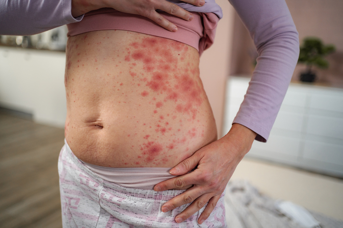 When to worry about a rash: An adult guide