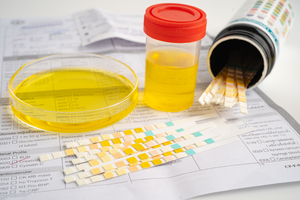 Glucose in urine: Symptoms, test, causes, and treatment