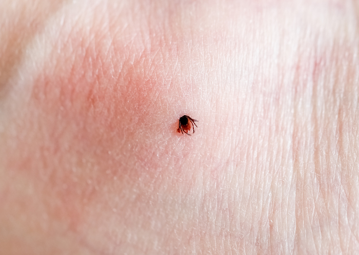 Tick bites: When to visit urgent care for Lyme disease prevention