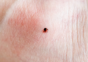 Tick bites: When to visit urgent care for Lyme disease prevention