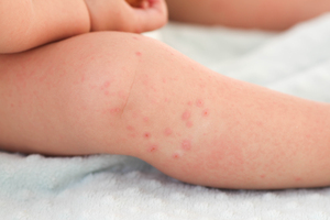 7 common childhood rashes: How to identify and treat them