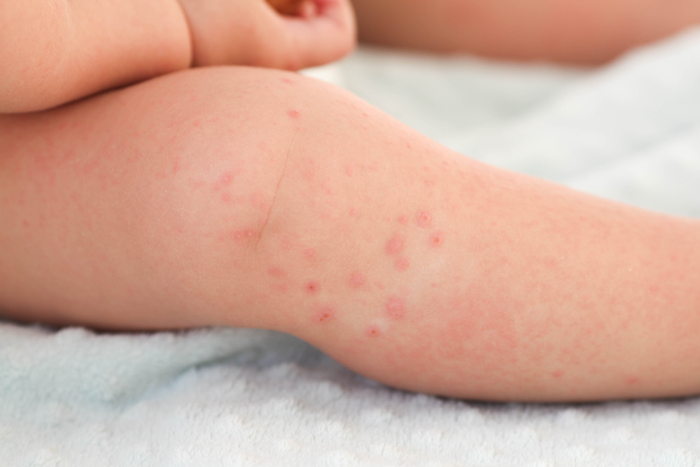 7 common childhood rashes: How to identify and treat them