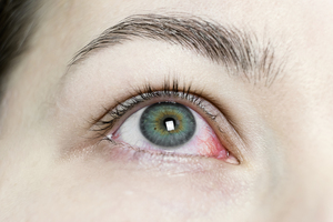 Urgent care for pink eye: What to expect during your visit